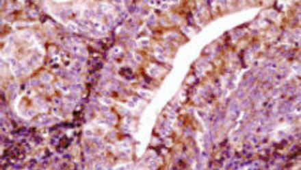 MT Feb 2013 Cancerous cells from the bladder of a water buffalo