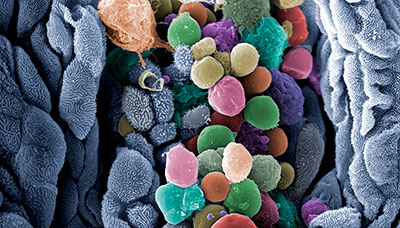 Coloured scanning electron micrograph of a salmon gill affected by amoebic gill disease (AGD)