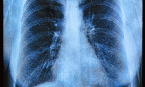 Chest X ray .jpg