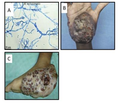 human fungal infections