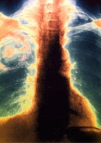 aspergillosis lung