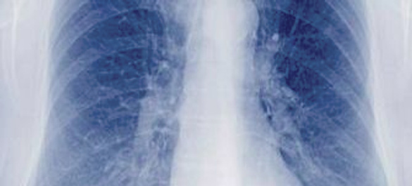X-ray image of tuberculosis in the lungs.