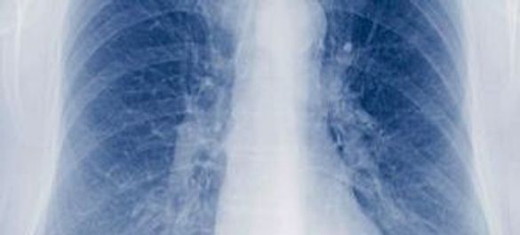 tuberculosis-2.jpg