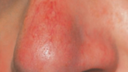 Rosacea