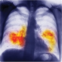 MT Feb 2013 Chest X-ray showing lung cancer