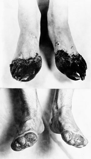 Trench Foot: Symptoms, Causes, Pictures, and Treatment