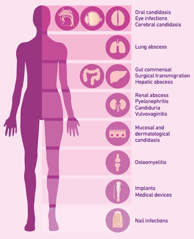 Systemic on sale candida infection