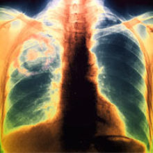 aspergillosis lung