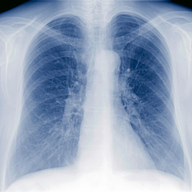 tuberculosis 2